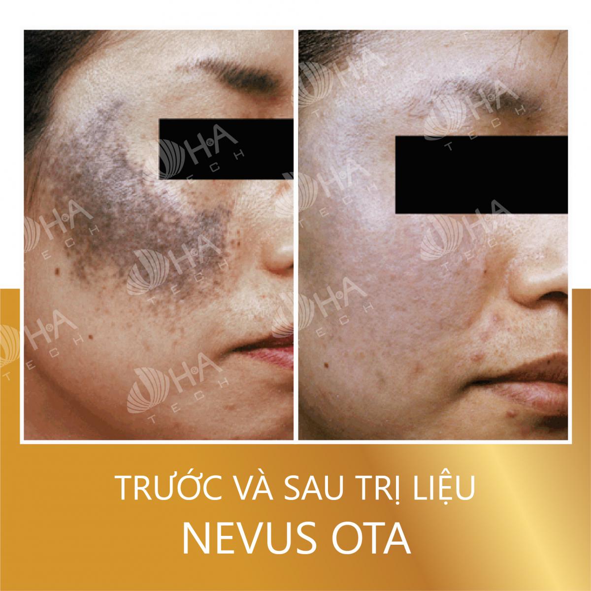 Hình ảnh Before After trị nám với Laser Helios 3