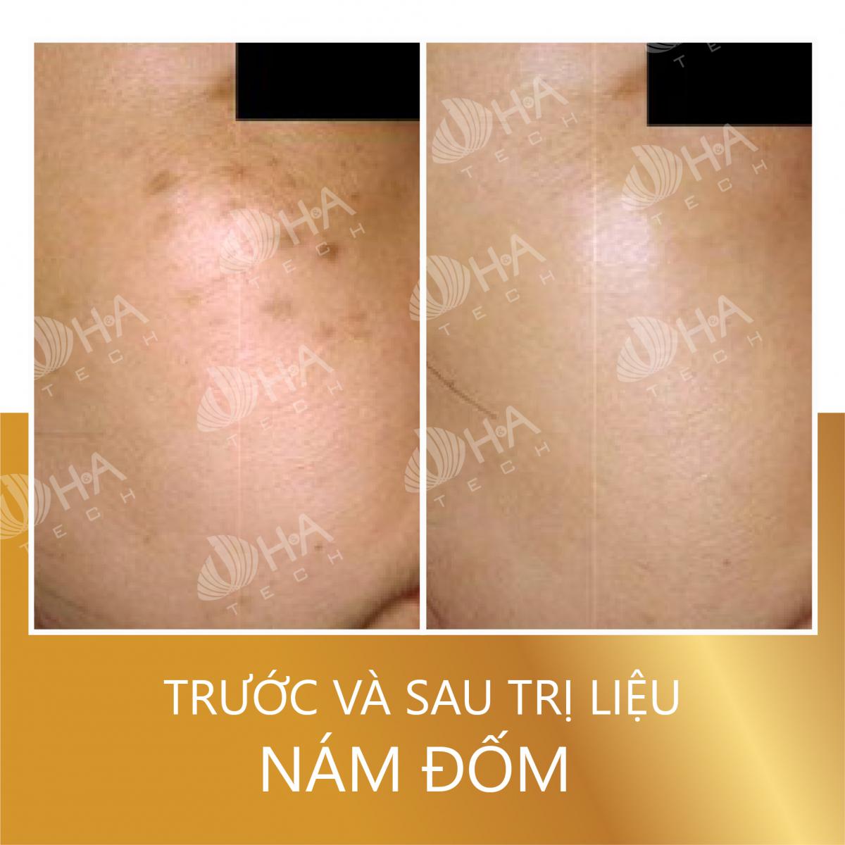 Hình ảnh trước sau trị nám với Laser Helios 3