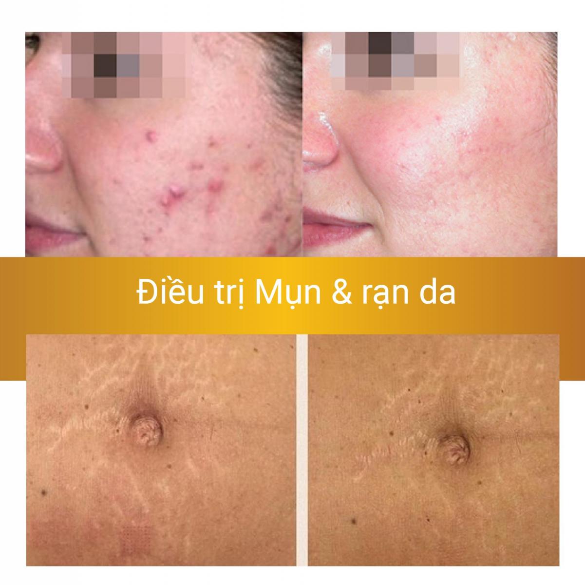 Hình ảnh Before After Laser trị nám Helios 3