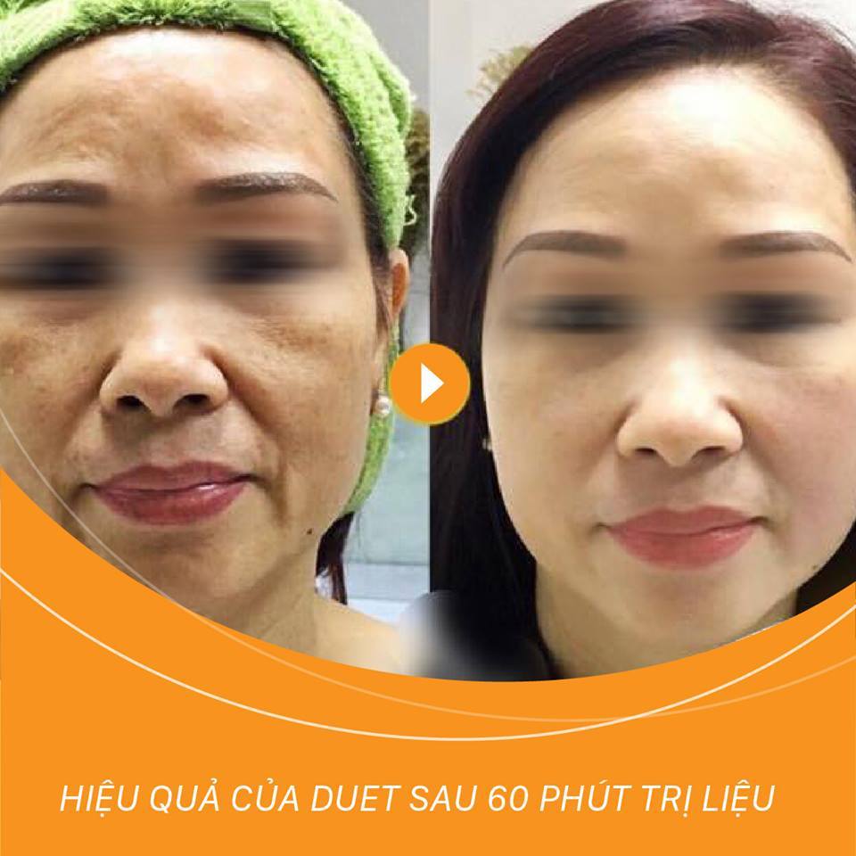 Hình ảnh Trước sau trị liệu nâng cơ Duet V